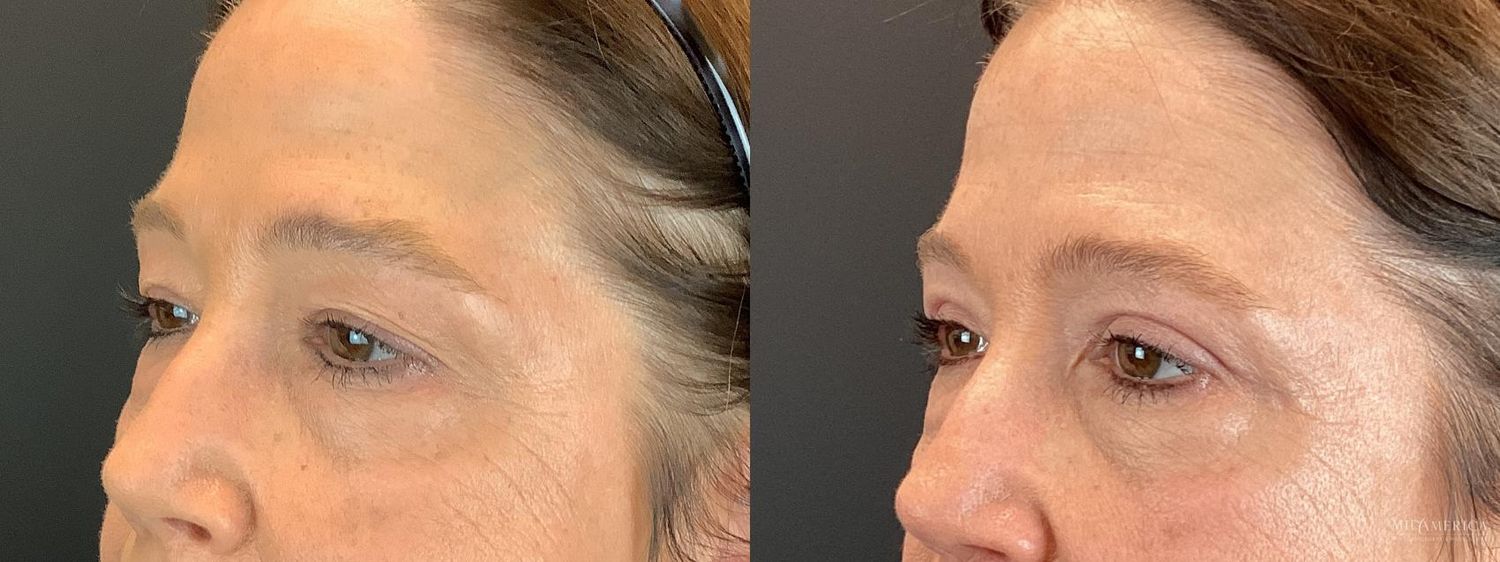 Eyelid Surgery Before & After