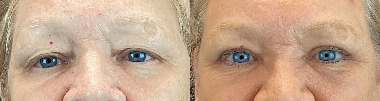 Eyelid Surgery Before & After