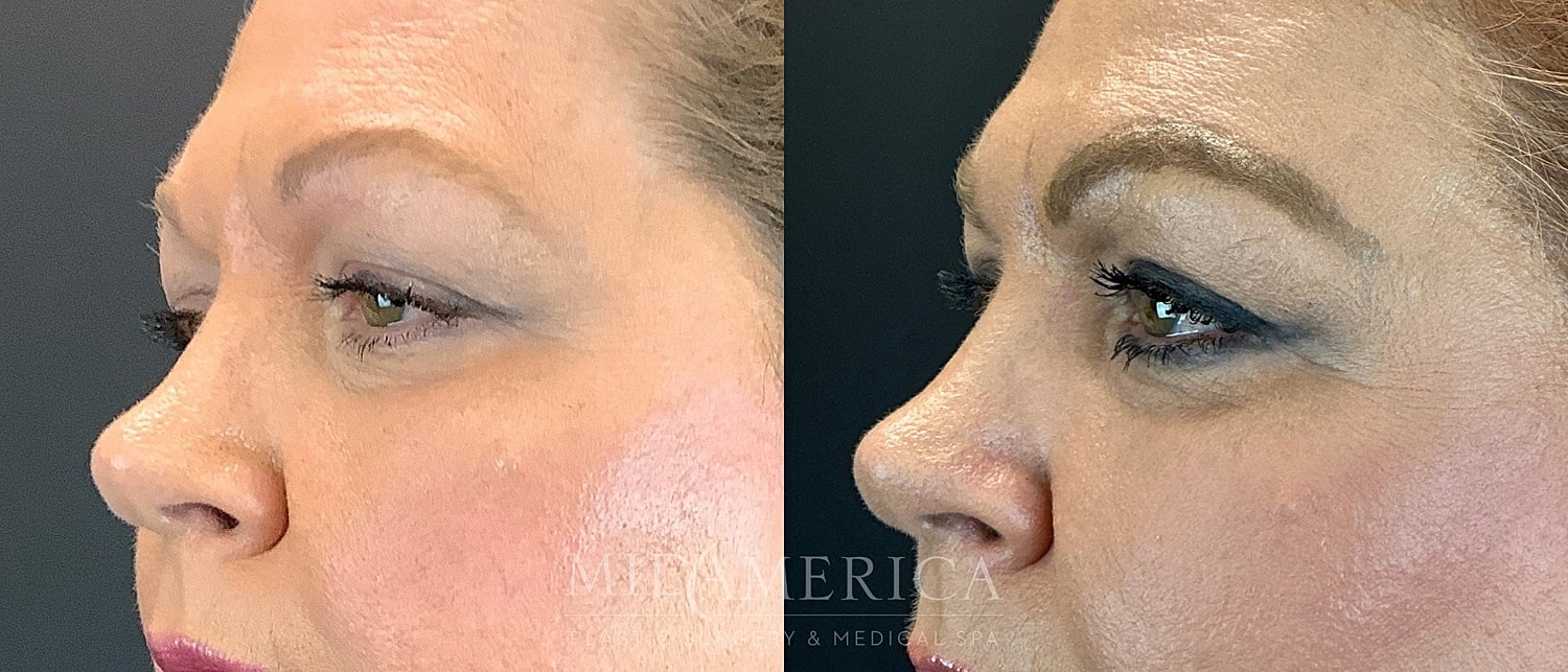 Eyelid Surgery Before & After