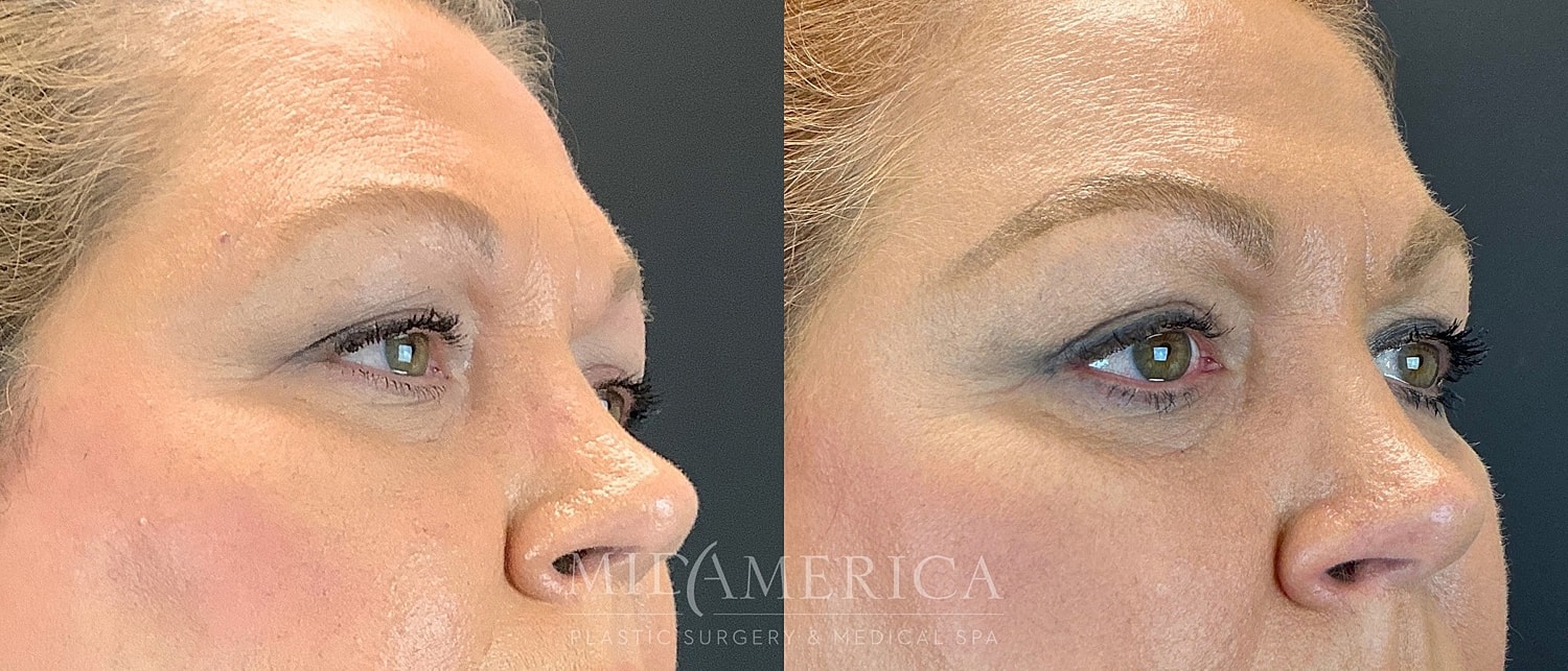 Eyelid Surgery Before & After