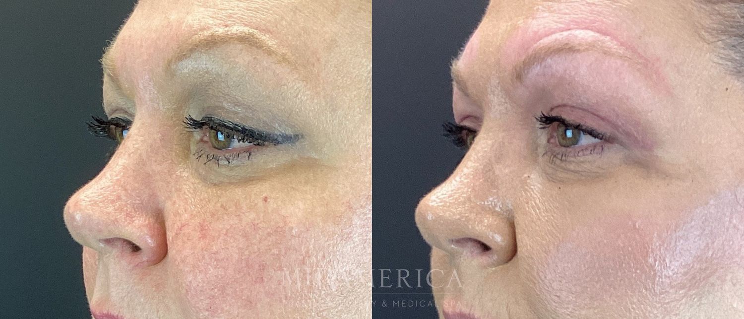 Eyelid Surgery Before & After