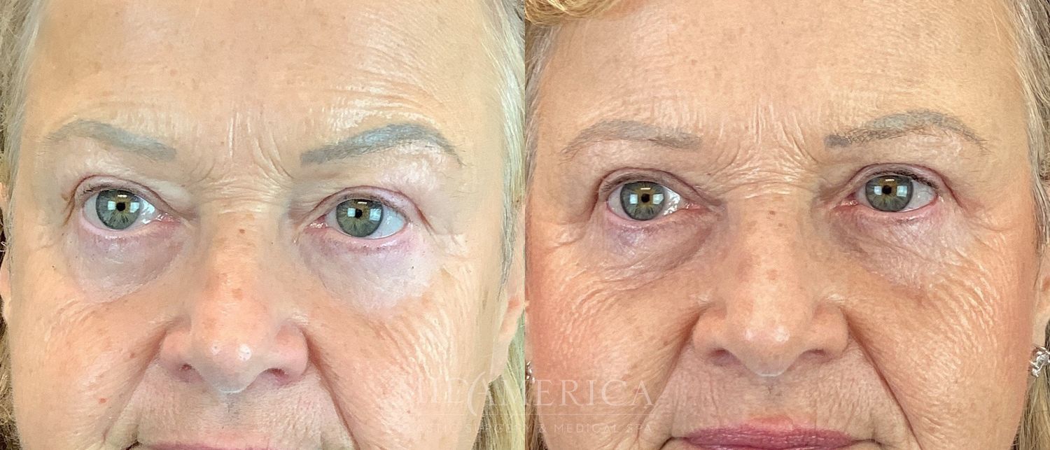 Eyelid Surgery Before & After