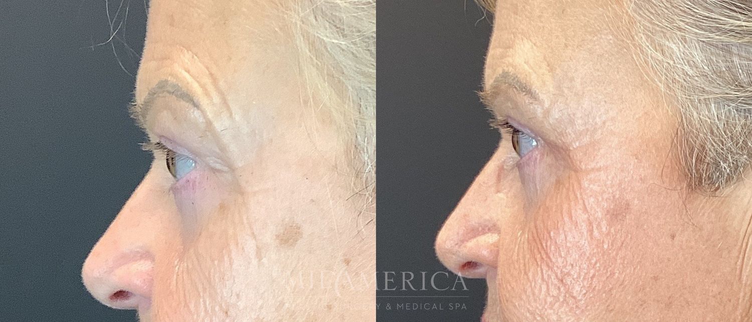 Eyelid Surgery Before & After