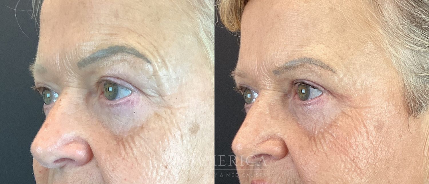 Eyelid Surgery Before & After