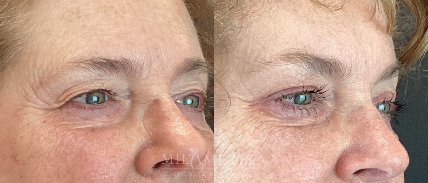 Eyelid Surgery Before & After