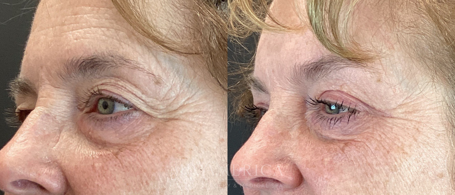 Eyelid Surgery Before & After