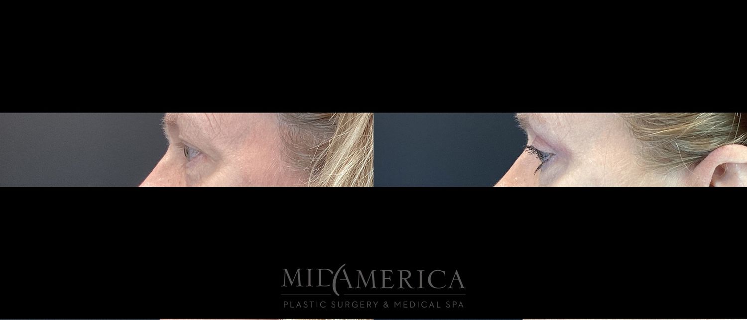 Eyelid Surgery Before & After