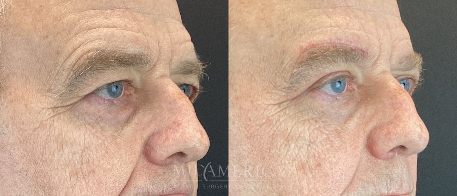 Eyelid Surgery Before & After