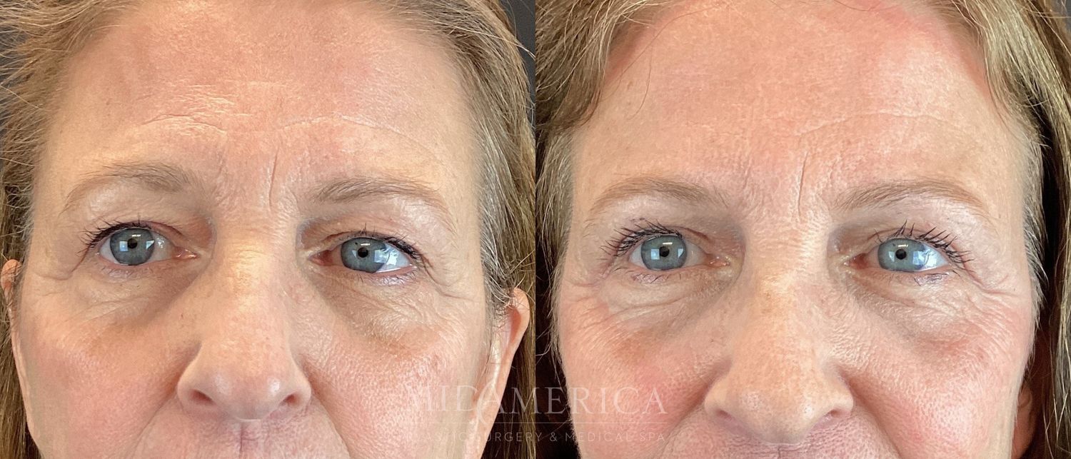 Eyelid Surgery Before & After