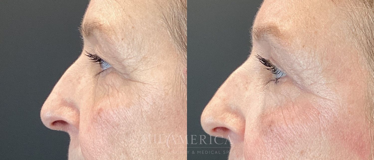 Eyelid Surgery Before & After