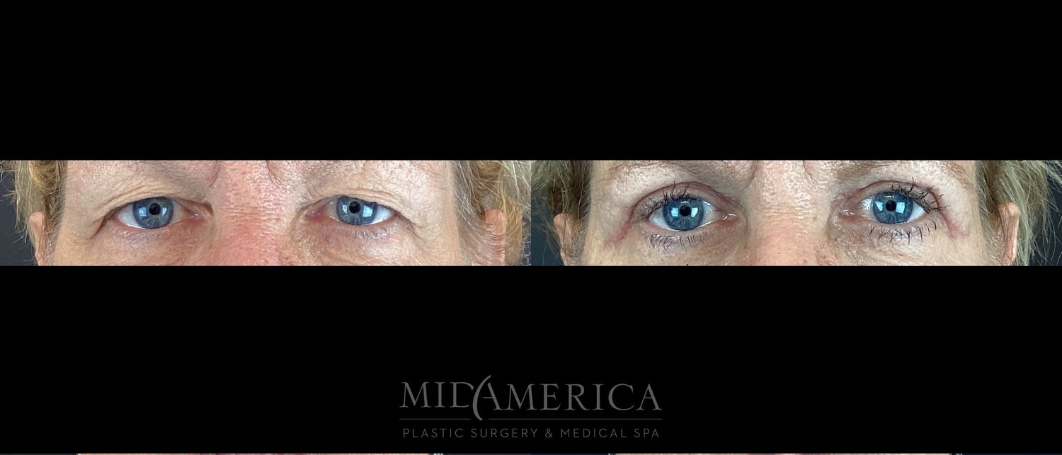 Eyelid Surgery Before & After