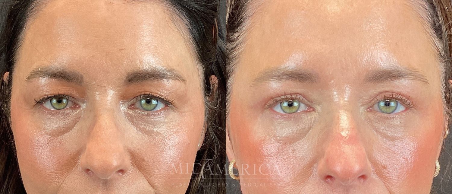 Eyelid Surgery Before & After