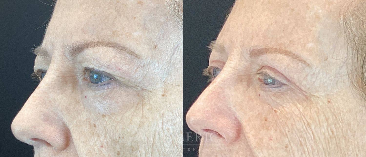 Eyelid Surgery Before & After