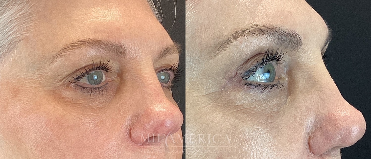 Eyelid Surgery Before & After