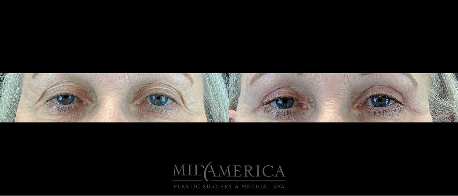 Eyelid Surgery Before & After