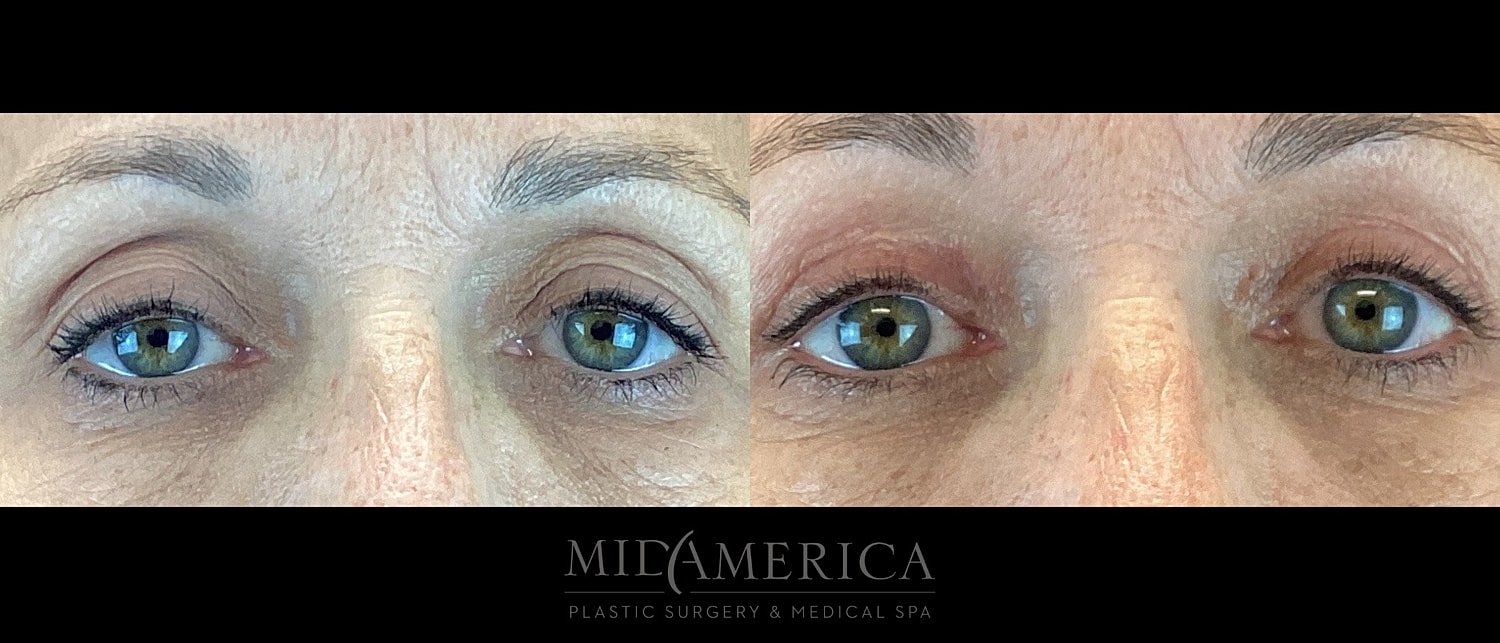 Eyelid Surgery Before & After