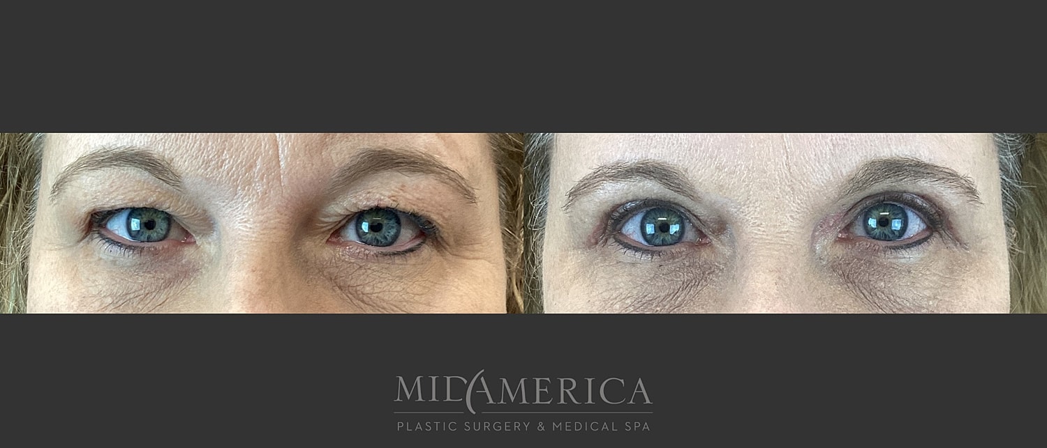 Eyelid Surgery Before & After