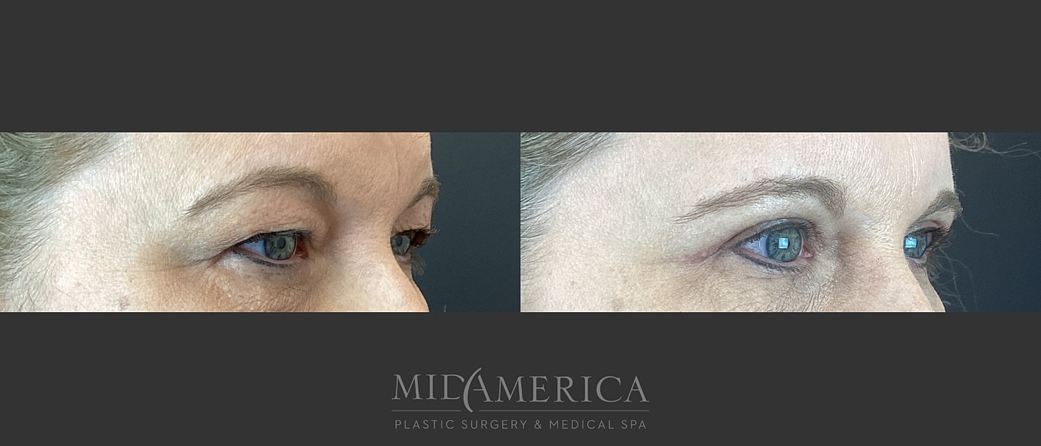 Eyelid Surgery Before & After