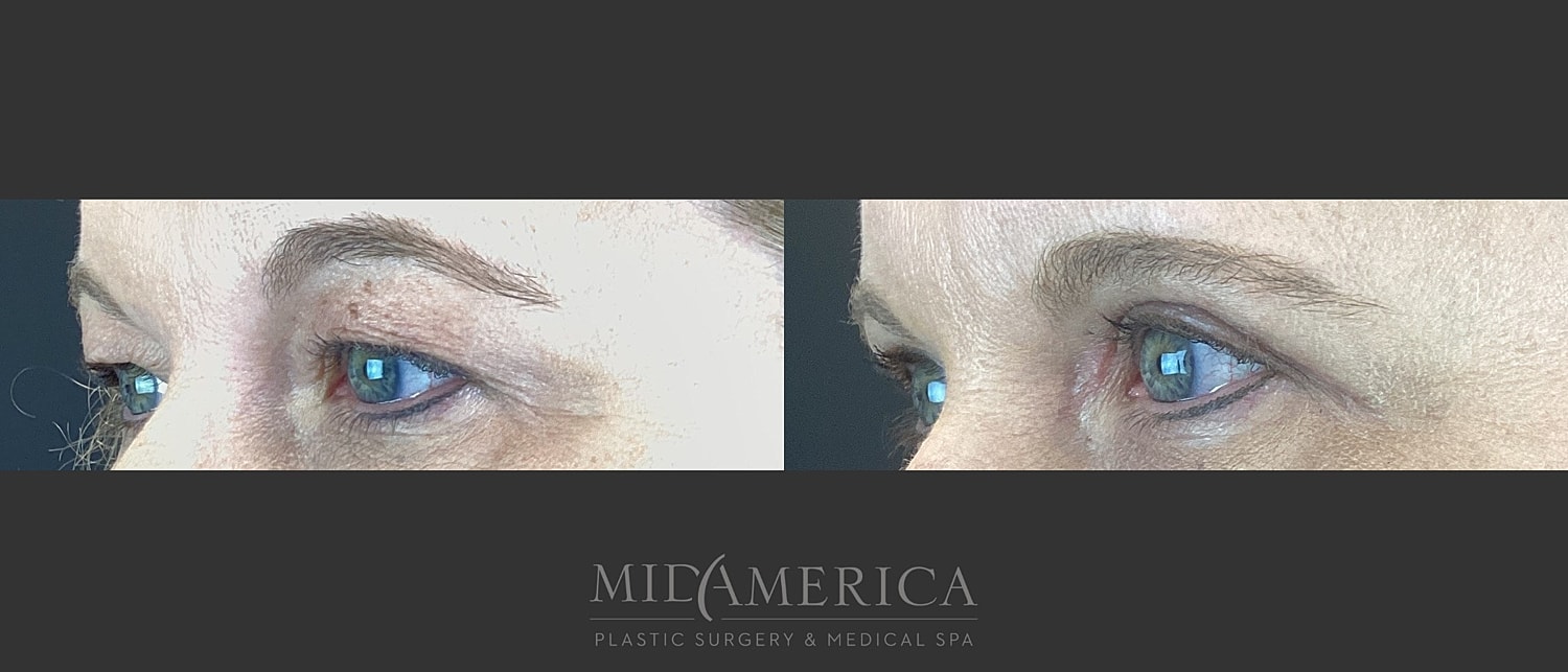 Eyelid Surgery Before & After