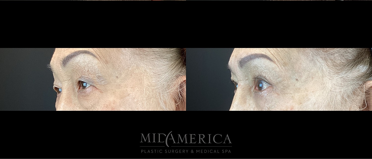 Eyelid Surgery Before & After