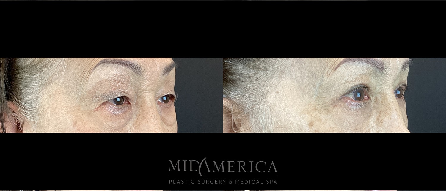 Eyelid Surgery Before & After