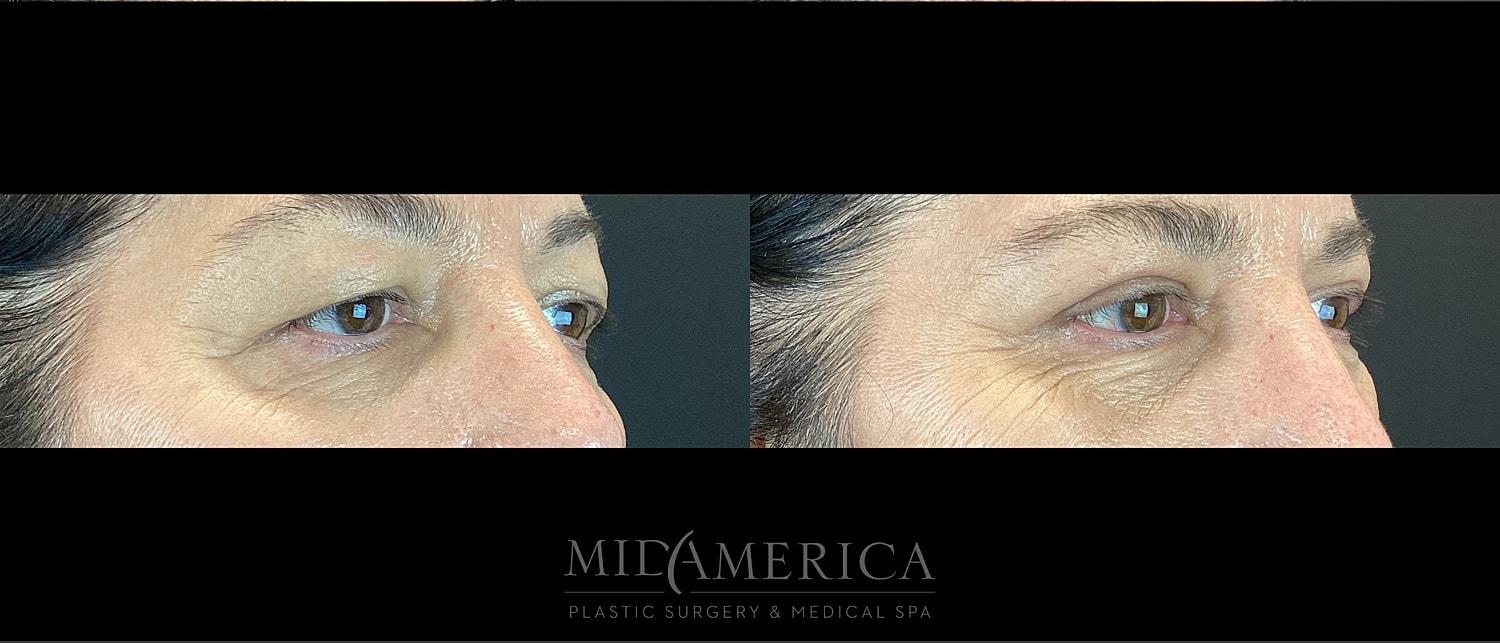 Eyelid Surgery Before & After