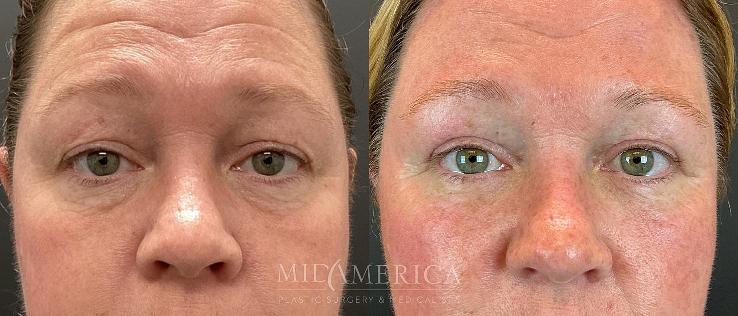 Eyelid Surgery Before & After