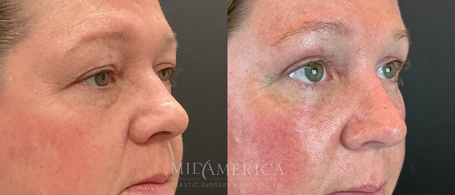 Eyelid Surgery Before & After
