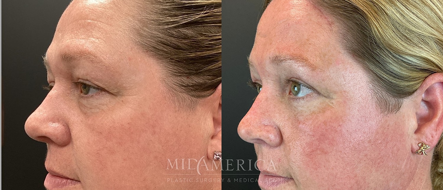 Eyelid Surgery Before & After