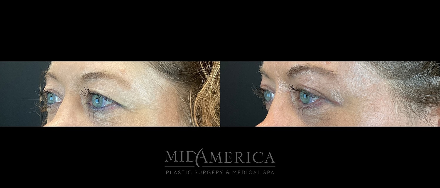 Eyelid Surgery Before & After