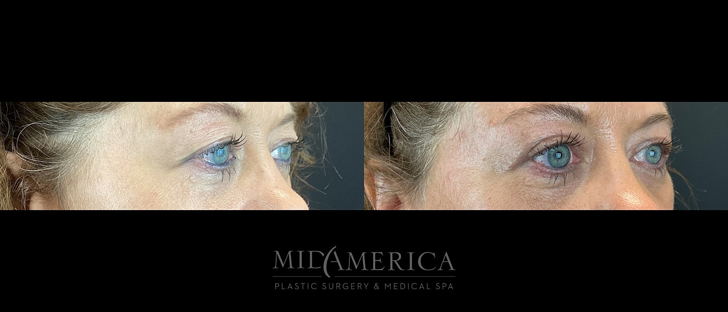 Eyelid Surgery Before & After