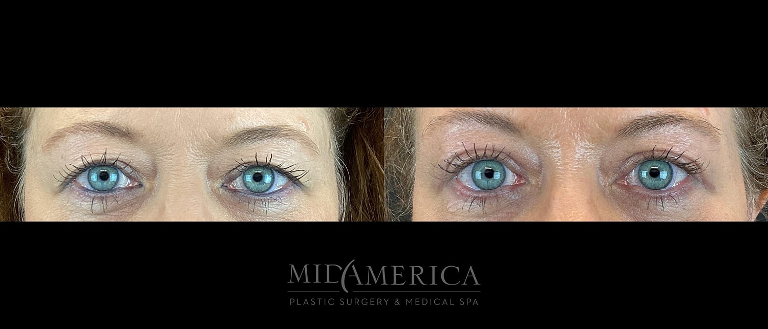 Eyelid Surgery Before & After