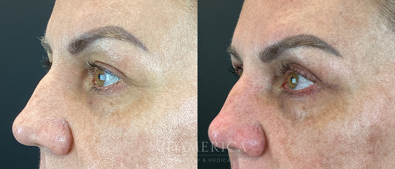 Eyelid Surgery Before & After