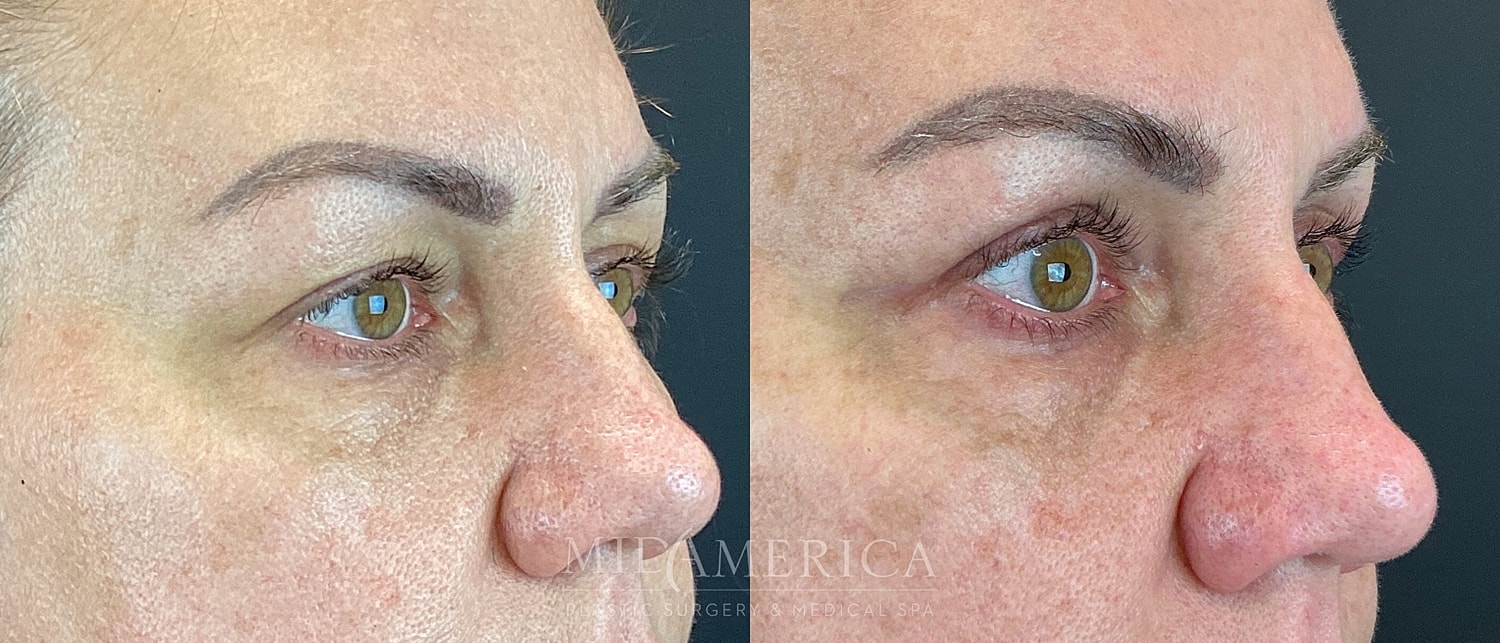 Eyelid Surgery Before & After