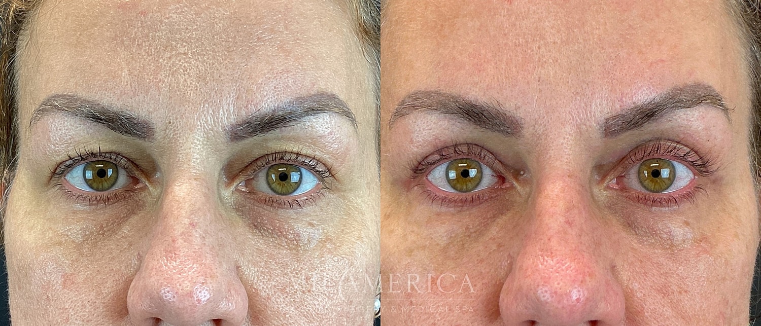 Eyelid Surgery Before & After