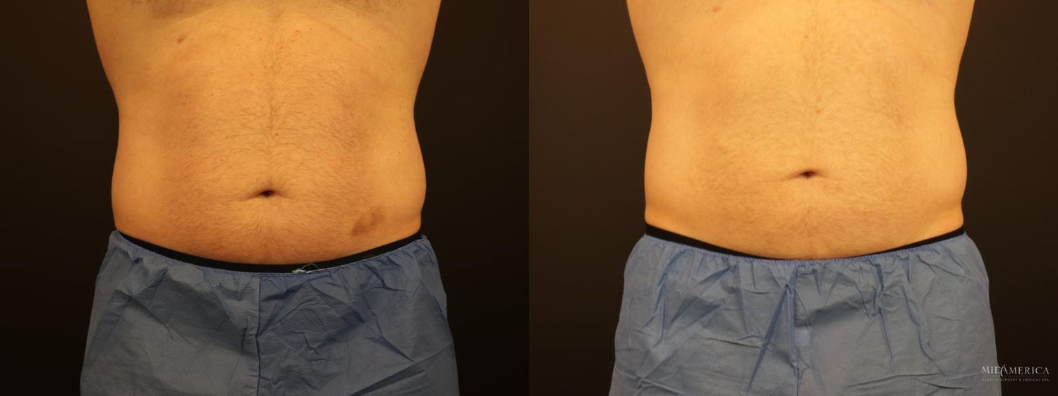 Coolsculpting Before & After