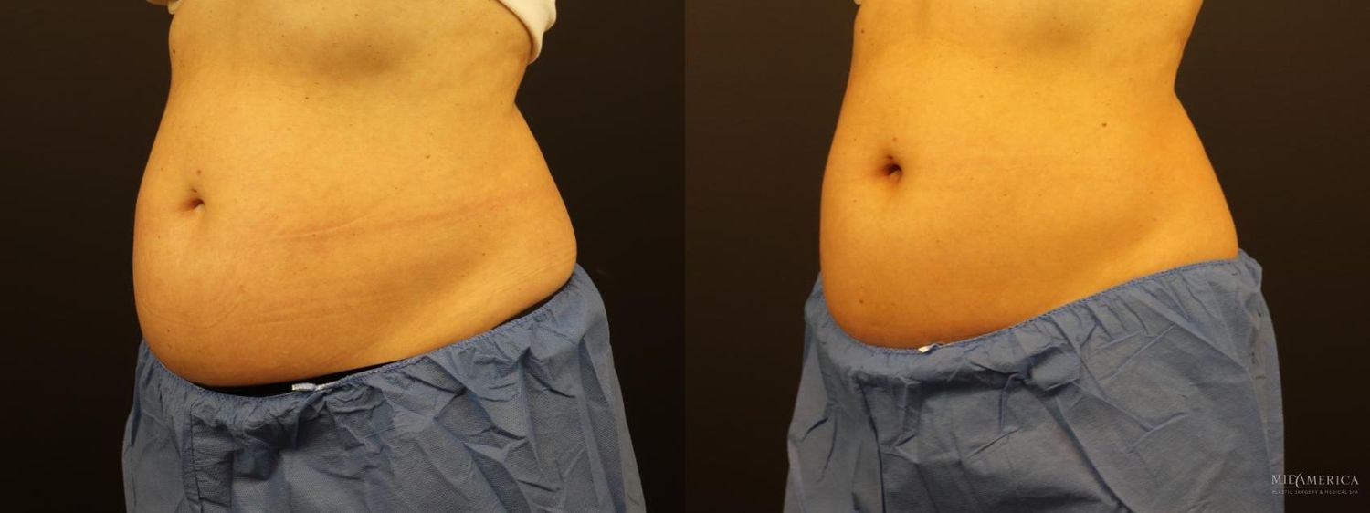 Coolsculpting Before & After