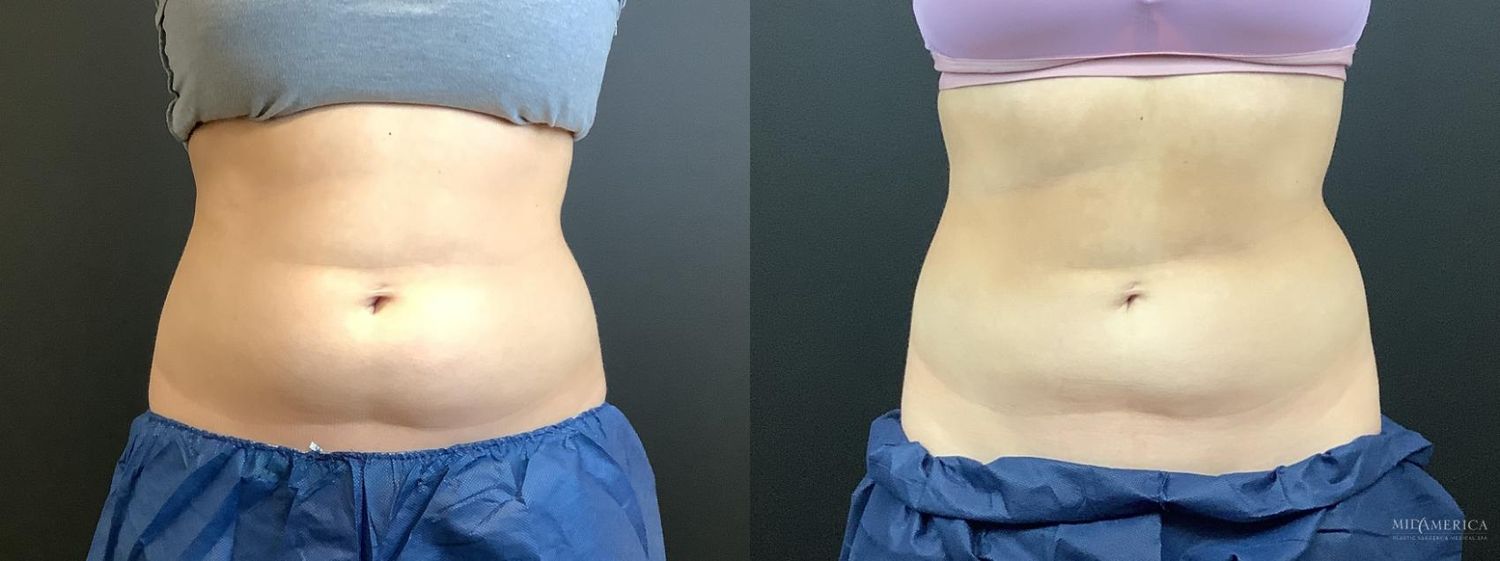 Coolsculpting Before & After