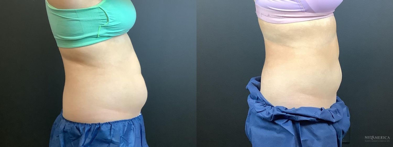 Coolsculpting Before & After