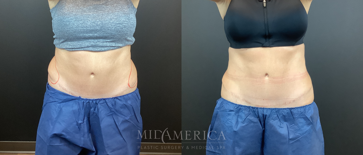 CoolSculpting Before & After