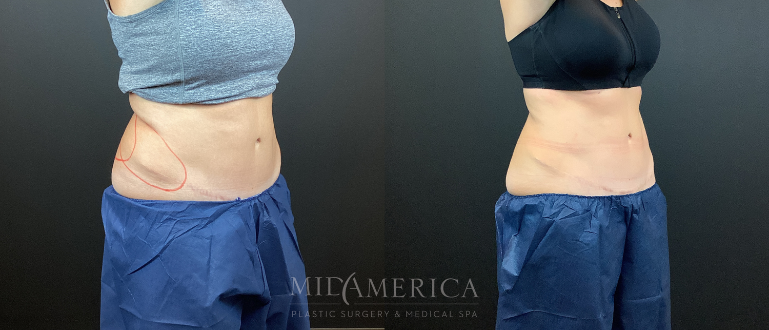 CoolSculpting Before & After