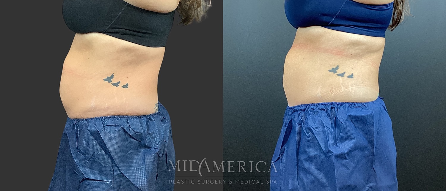 CoolSculpting Before & After