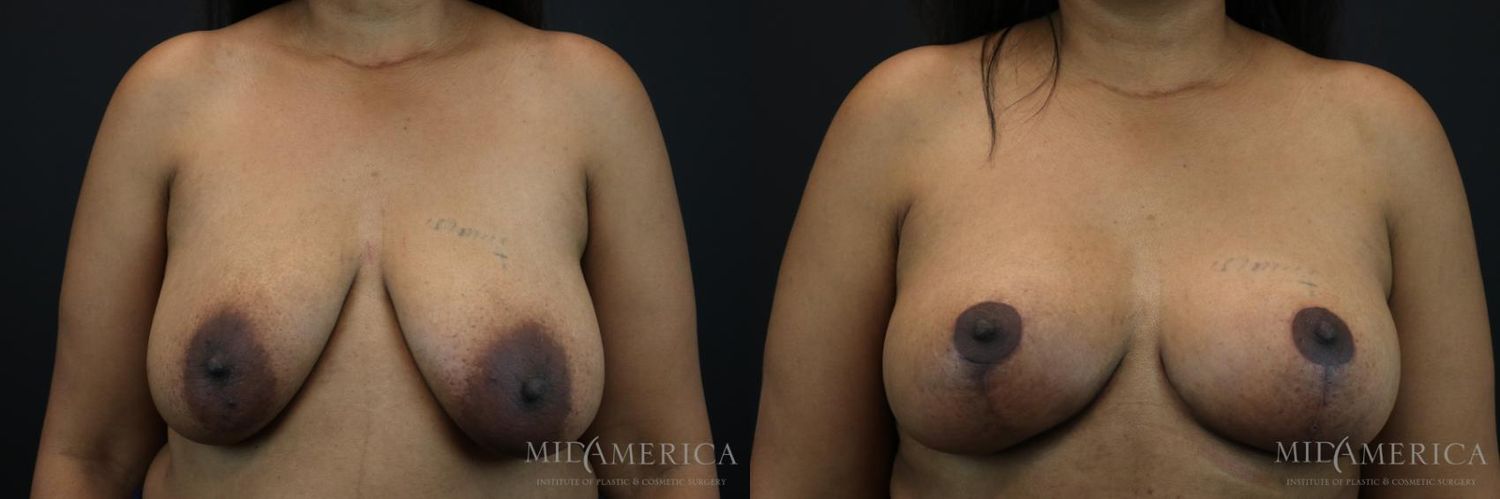 Breast Lift Before & After
