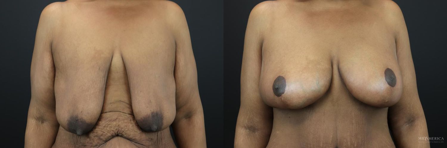 Breast Lift Before & After