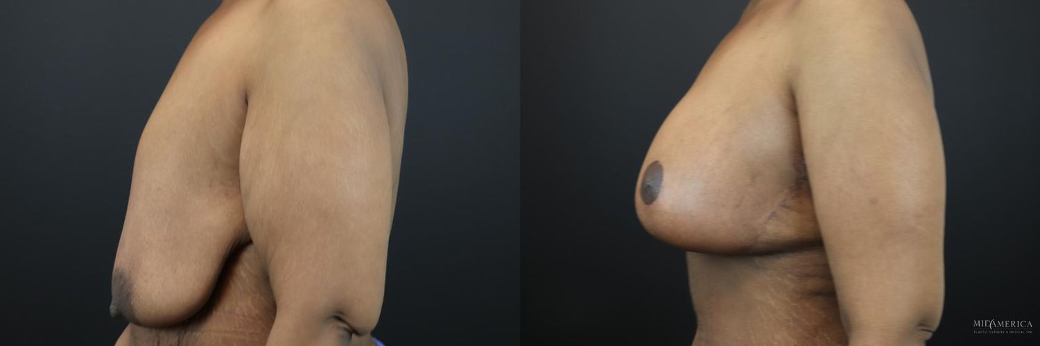Breast Lift Before & After