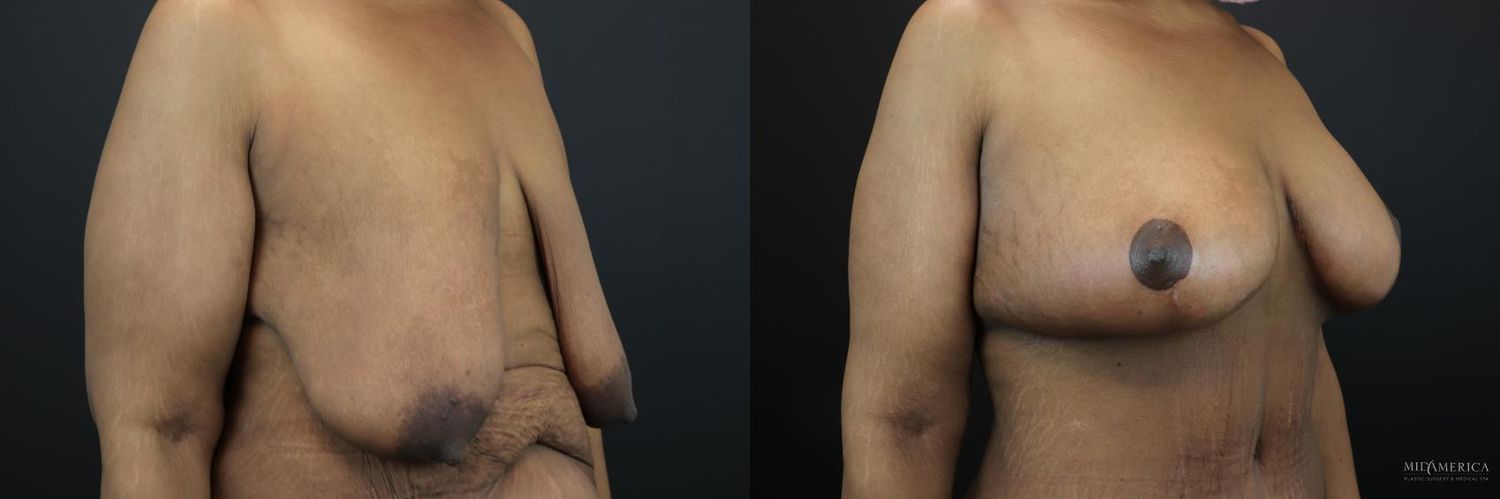 Breast Lift Before & After