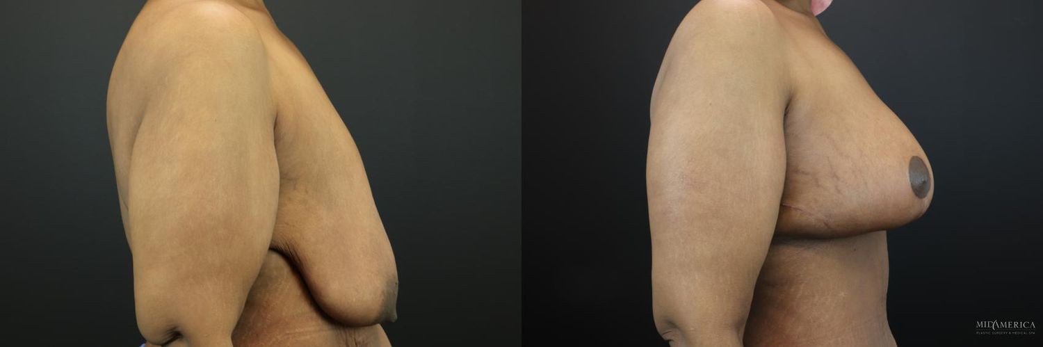 Breast Lift Before & After