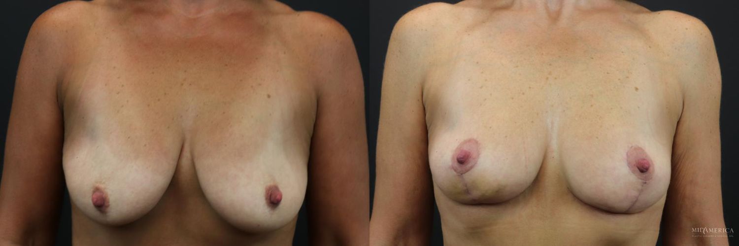 Breast Lift Before & After