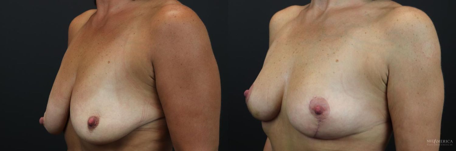 Breast Lift Before & After