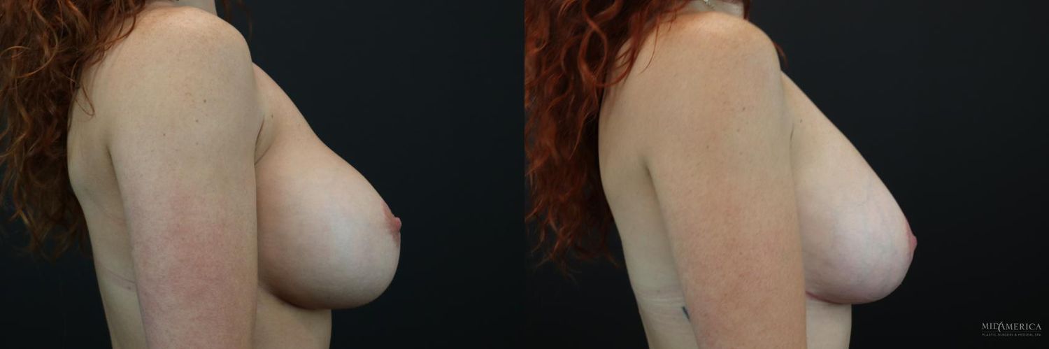 Breast Lift Before & After